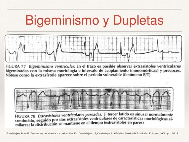 extrasistoles ventriculares bigeminismo